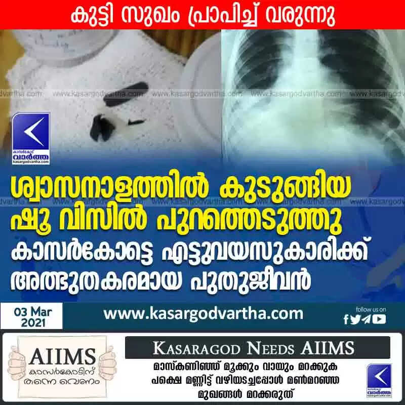 ശ്വാസനാളത്തില് കുടുങ്ങിയ ഷൂ വിസില് പുറത്തെടുത്തു; കാസർകോട്ടെ എട്ടുവയസുകാരിക്ക് അത്ഭുതകരമായ പുതുജീവൻ