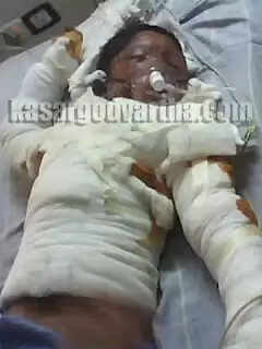 ഓംലെറ്റ് ഉണ്ടാക്കുമ്പോള് ശരീരം പൊള്ളിയ മഷ്ഹൂദിന് നുറുങ്ങുന്ന വേദന