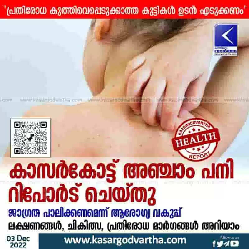 Measles | കാസര്കോട്ട് അഞ്ചാം പനി റിപോര്ട് ചെയ്തു; ജാഗ്രത പാലിക്കണമെന്ന് ആരോഗ്യ വകുപ്പ്; ലക്ഷണങ്ങള്, ചികിത്സ, പ്രതിരോധ മാര്ഗങ്ങള് അറിയാം