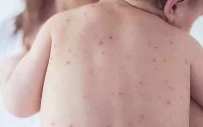 Measles | കാസര്കോട്ട് അഞ്ചാം പനി റിപോര്ട് ചെയ്തു; ജാഗ്രത പാലിക്കണമെന്ന് ആരോഗ്യ വകുപ്പ്; ലക്ഷണങ്ങള്, ചികിത്സ, പ്രതിരോധ മാര്ഗങ്ങള് അറിയാം