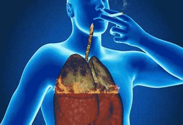 Lung Cancer | ശ്വാസകോശ കാൻസർ പുകവലിക്കാത്തവരിൽ വരാം; കാരണങ്ങൾ
