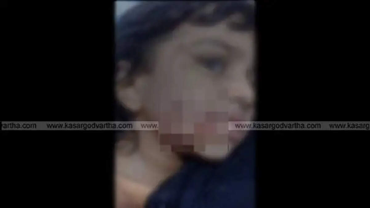 3-year-old child bitten by street dog in Kasargod
