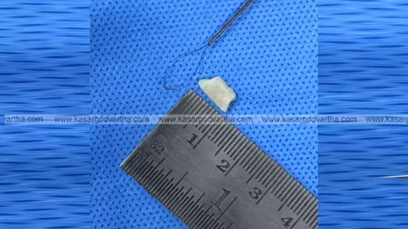  Medical team at Aster MIMS Kasaragod who performed the successful bronchoscopy on the child.