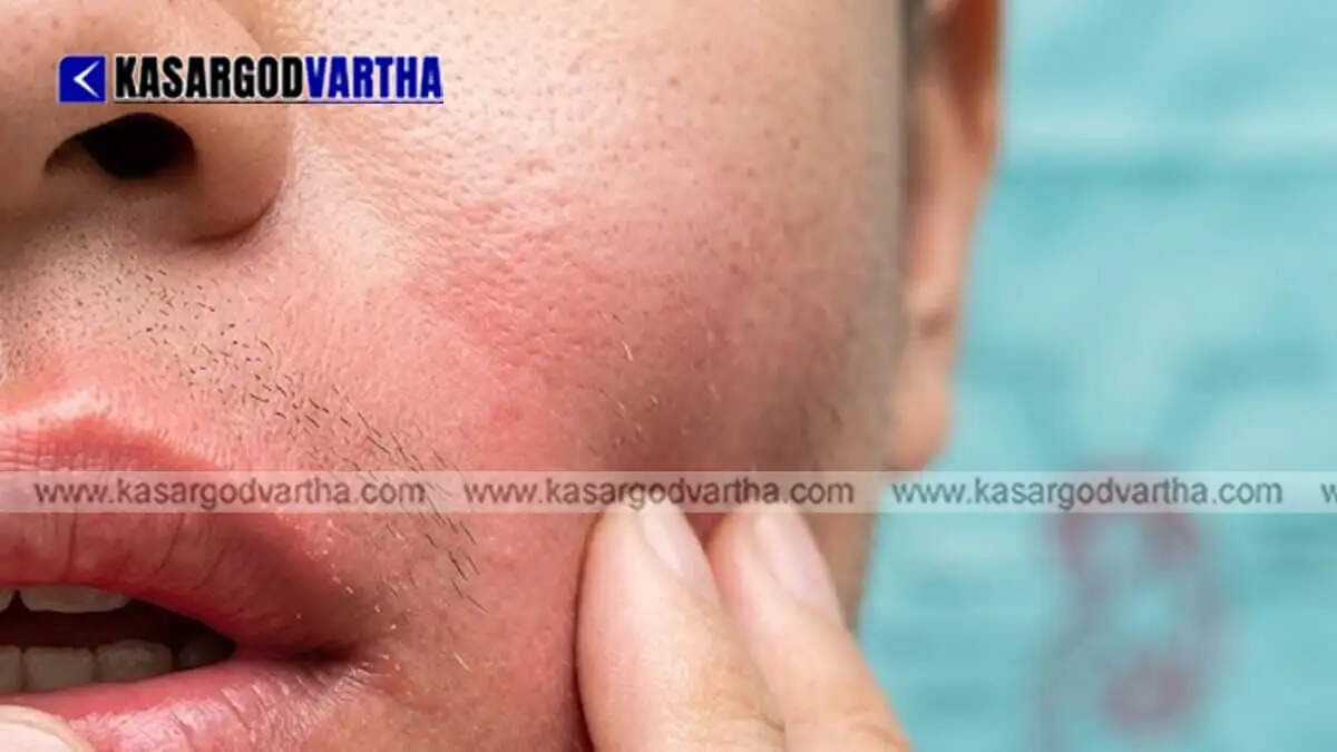 Image Representing District Collector declares 21-day holiday for Thumpoly SNV LP School in Alappuzha following mumps outbreak