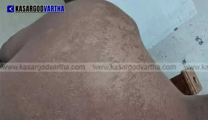 13-year-old boy suffers sunstroke while playing in Kanhangad; hospitalized after hiding burns for a week